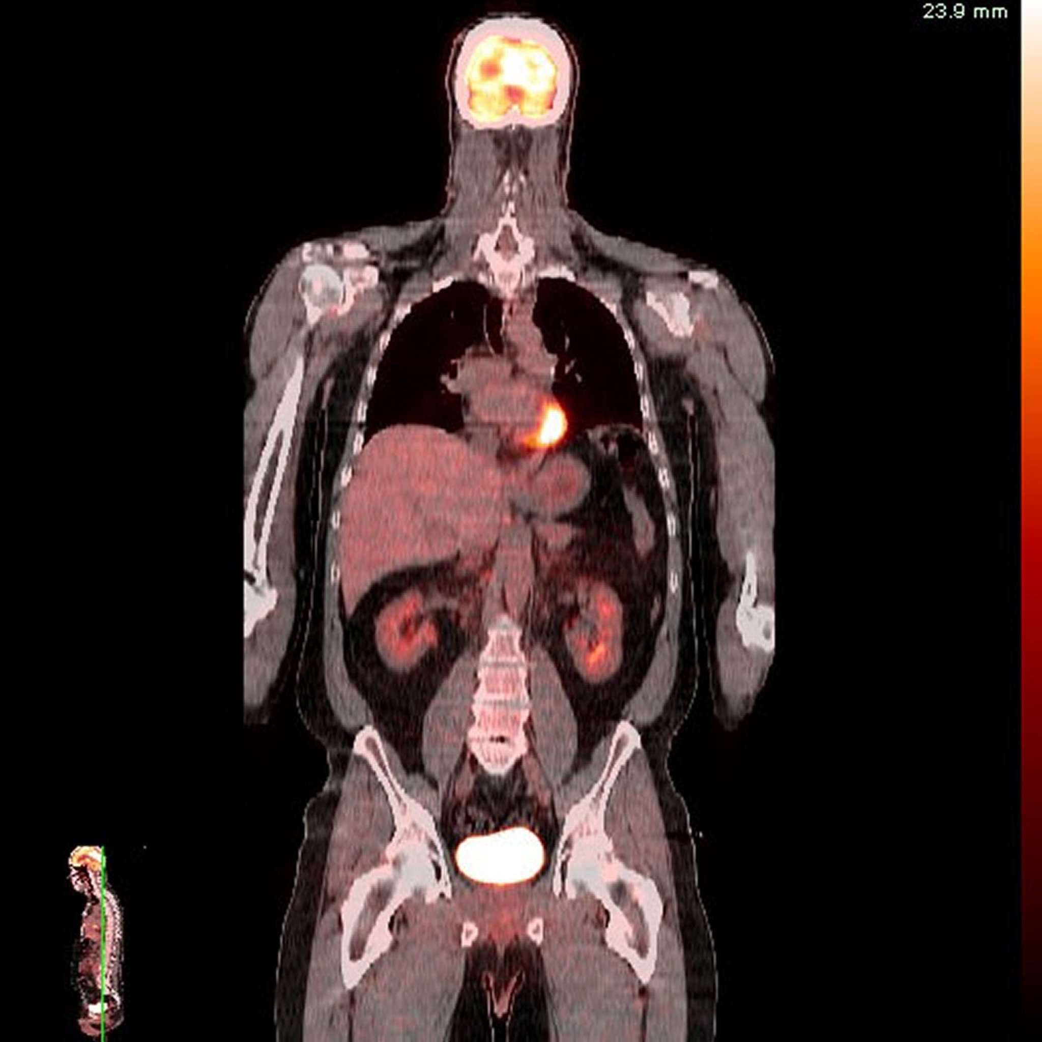 Tomografi Emisi Positron-Tomografi Terkomputasi (PET-CT)