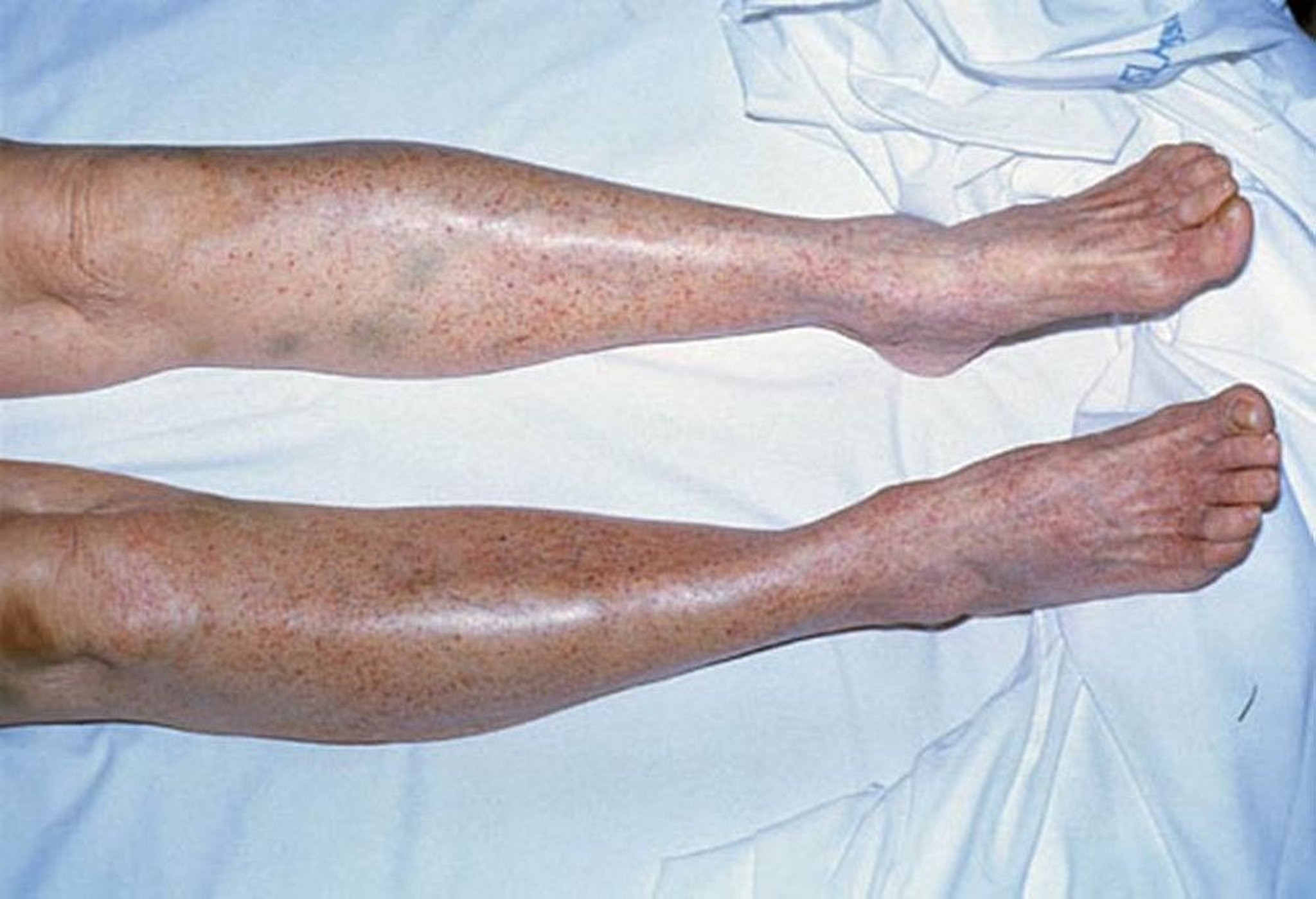 Petechiae (Ngozi)