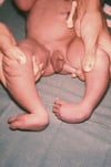 Piedi a piccozza nella trisomia 18