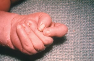 Ngumi Iliyokunjwa katika Traisomi 18