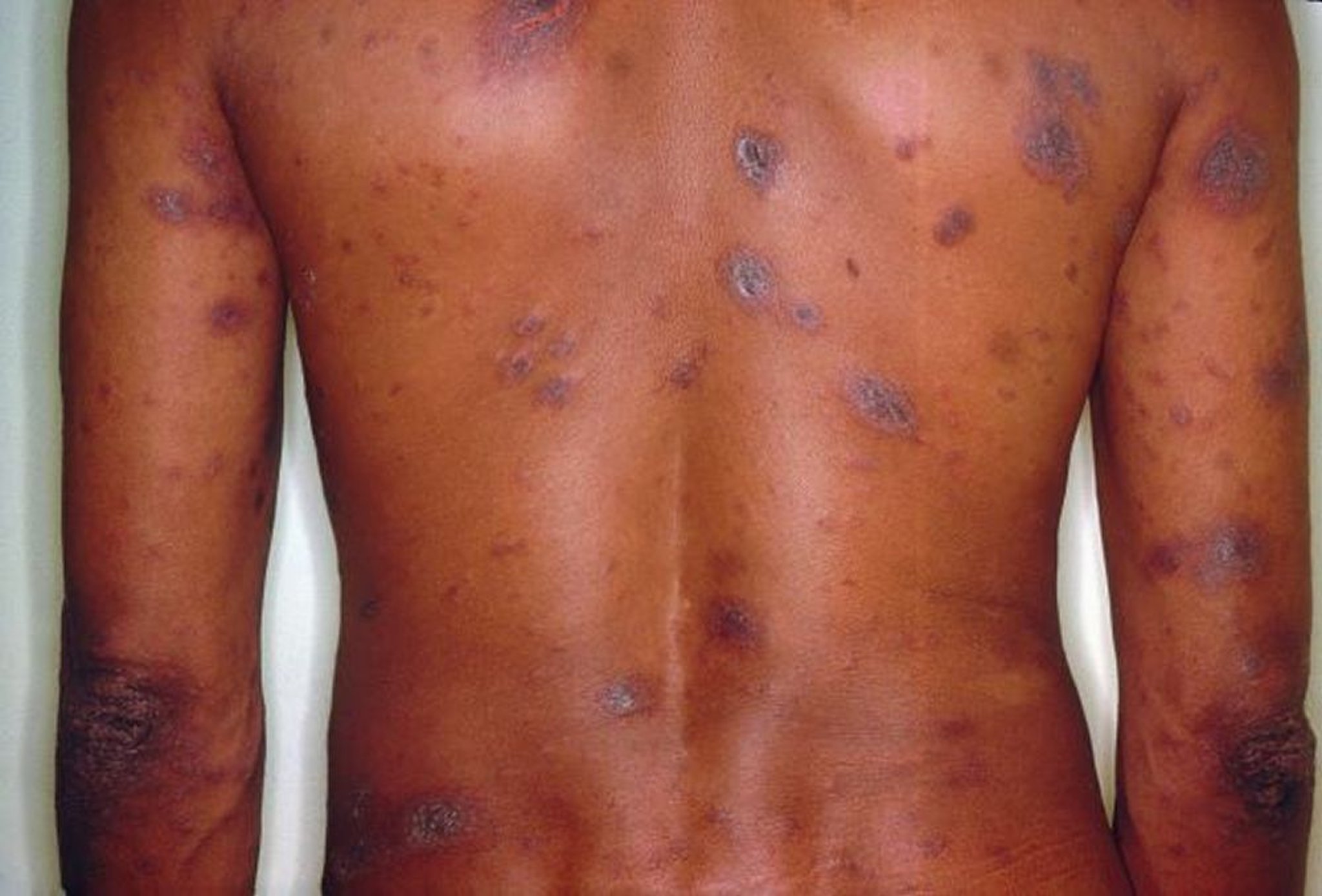 Pitiriasis rosada (1)