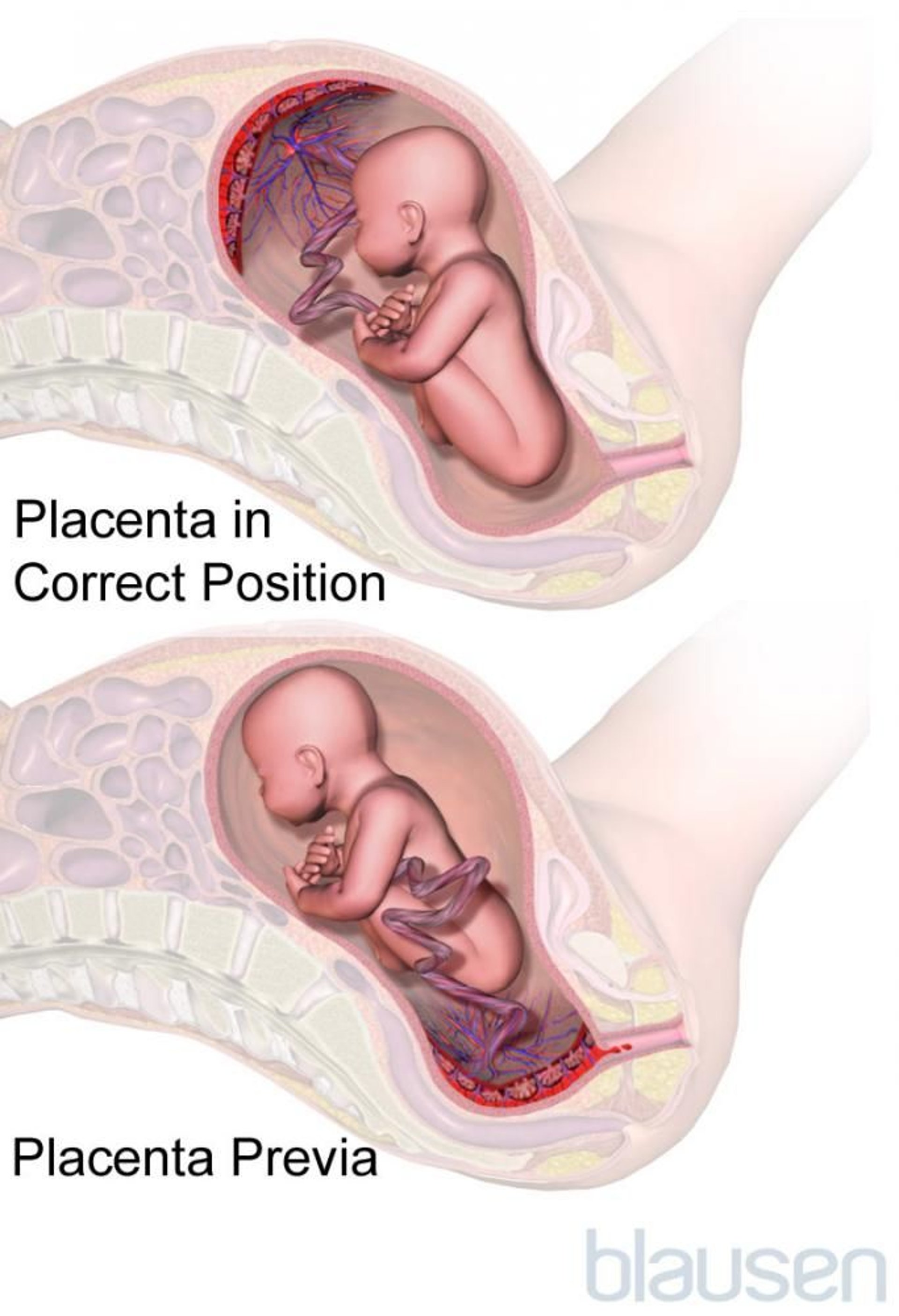 Placenta previa