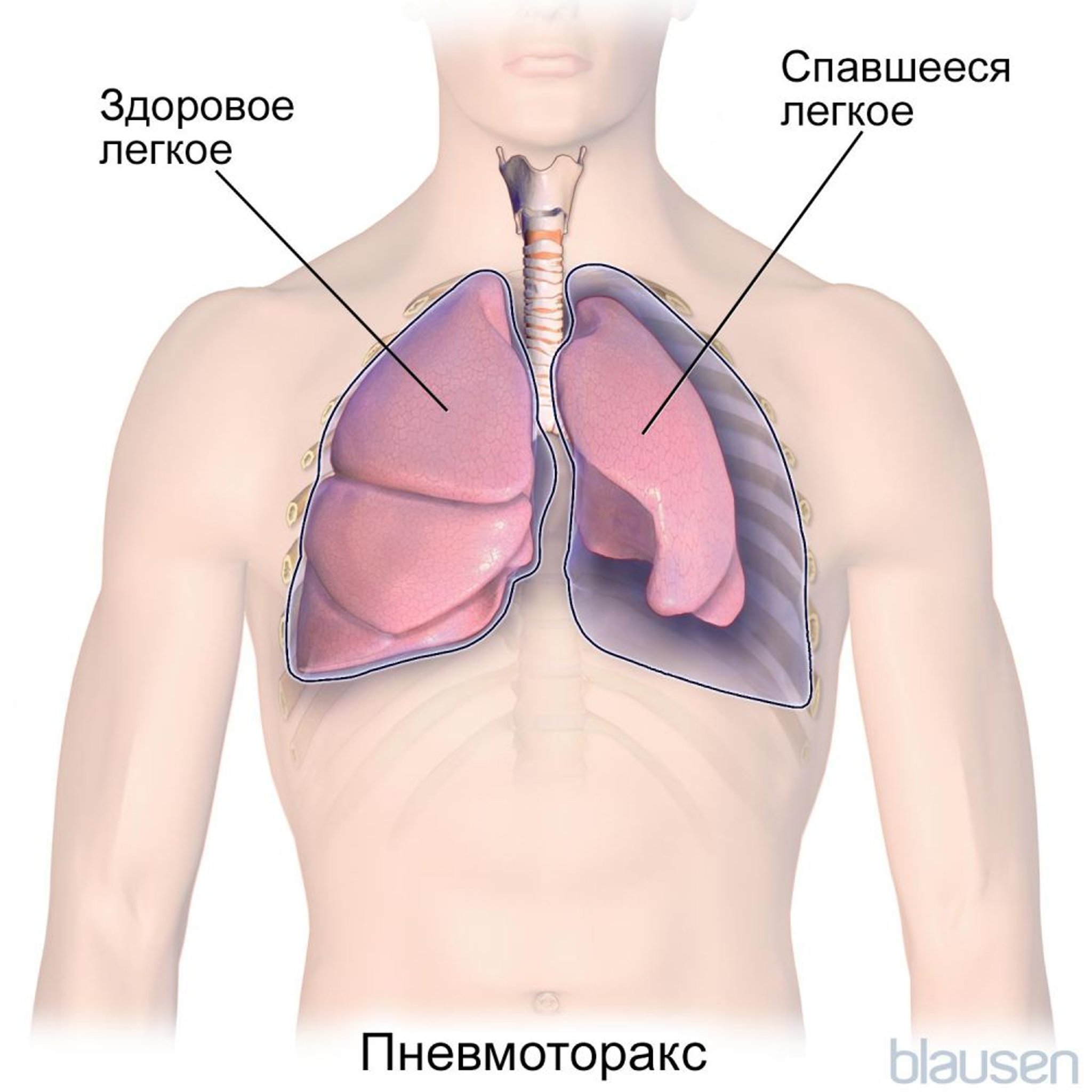 Пневмоторакс