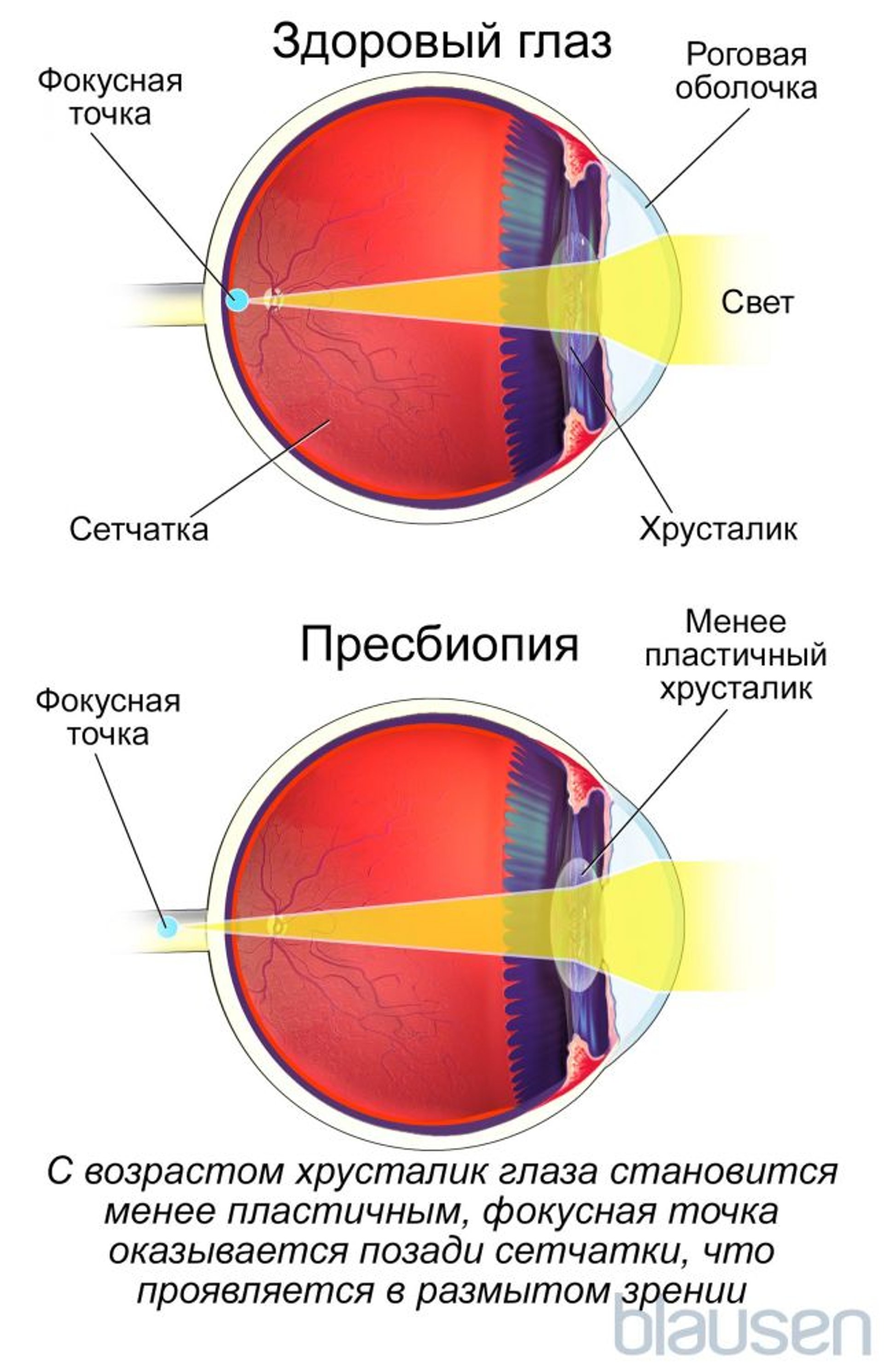 Пресбиопия