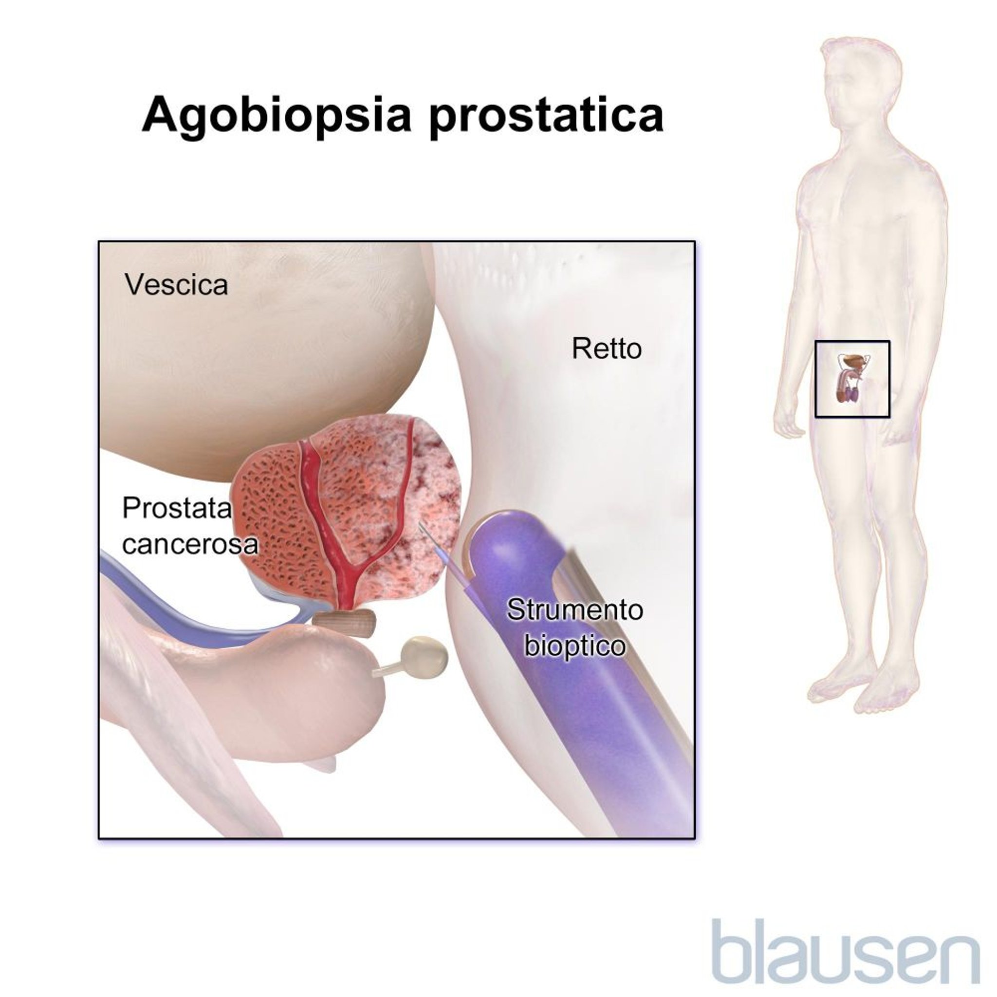 Agobiopsia della prostata (transrettale)