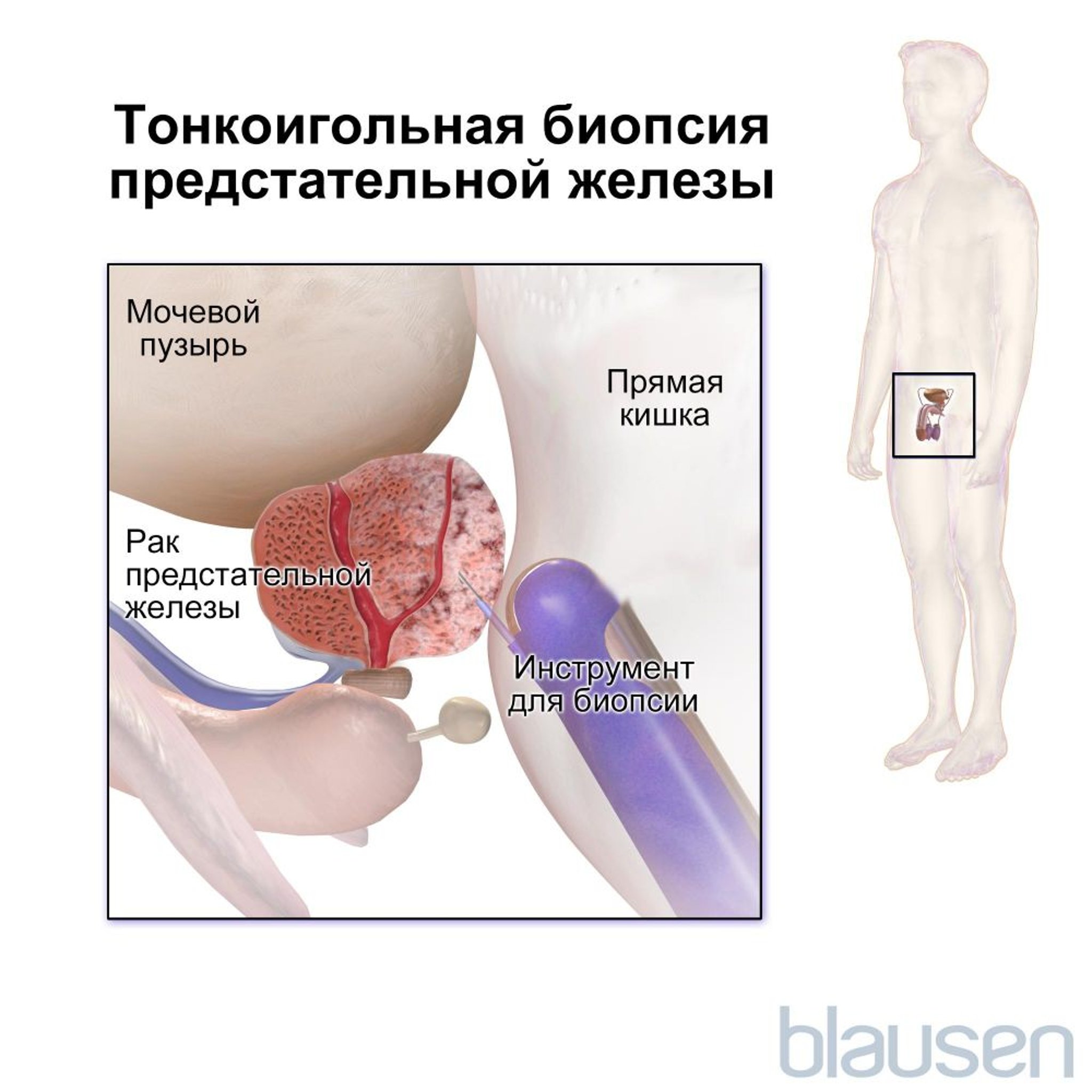 Игольная биопсия предстательной железы (трансректальная)