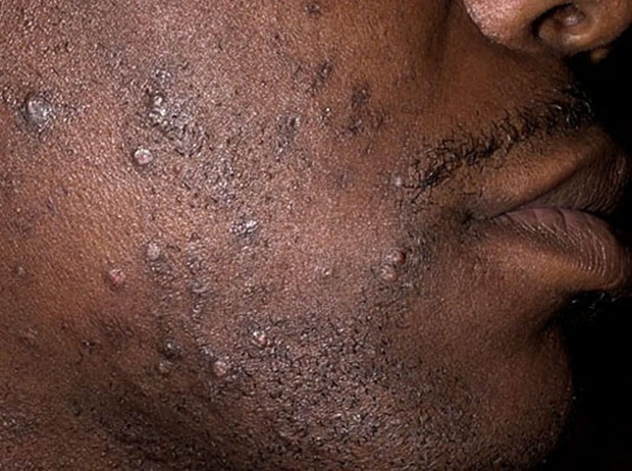 Peli della barba incarniti (pseudofolliculitis barbae)