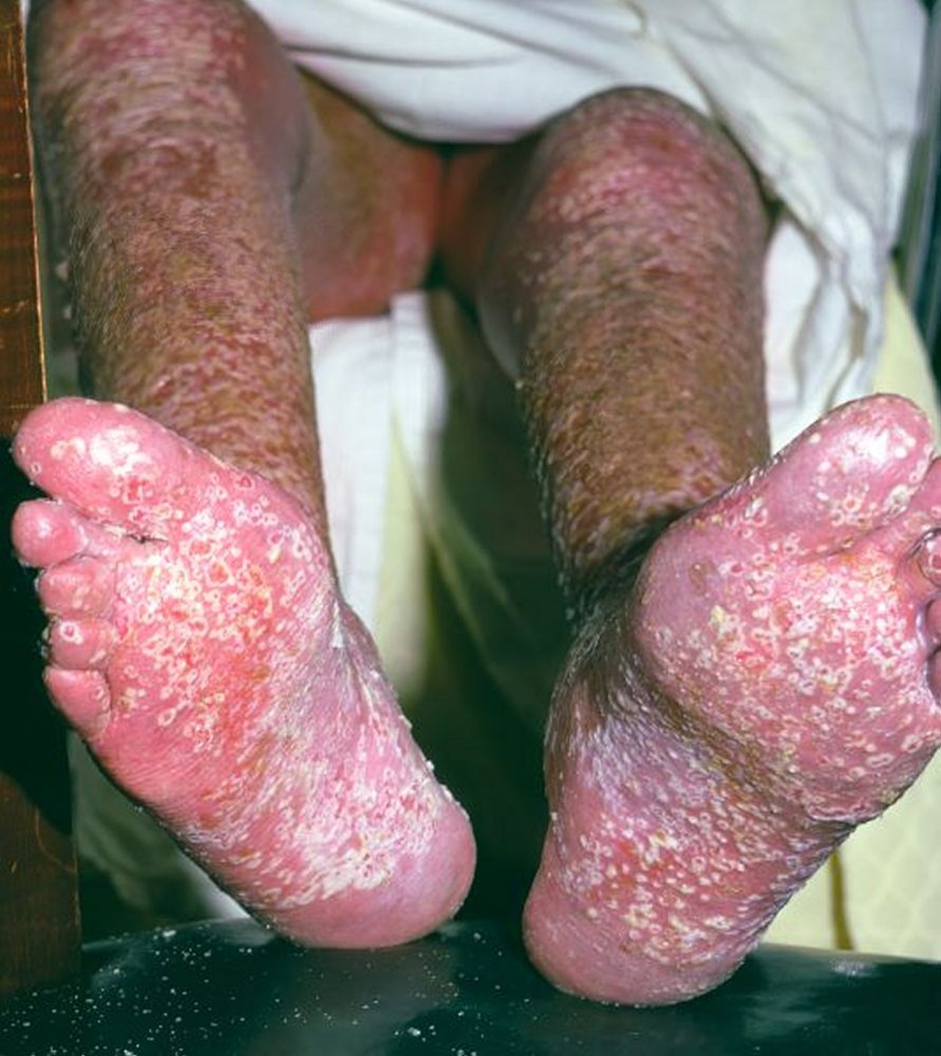 Psoriasisi ya Chunusi (Miguu)