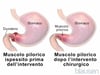 Stenosi pilorica