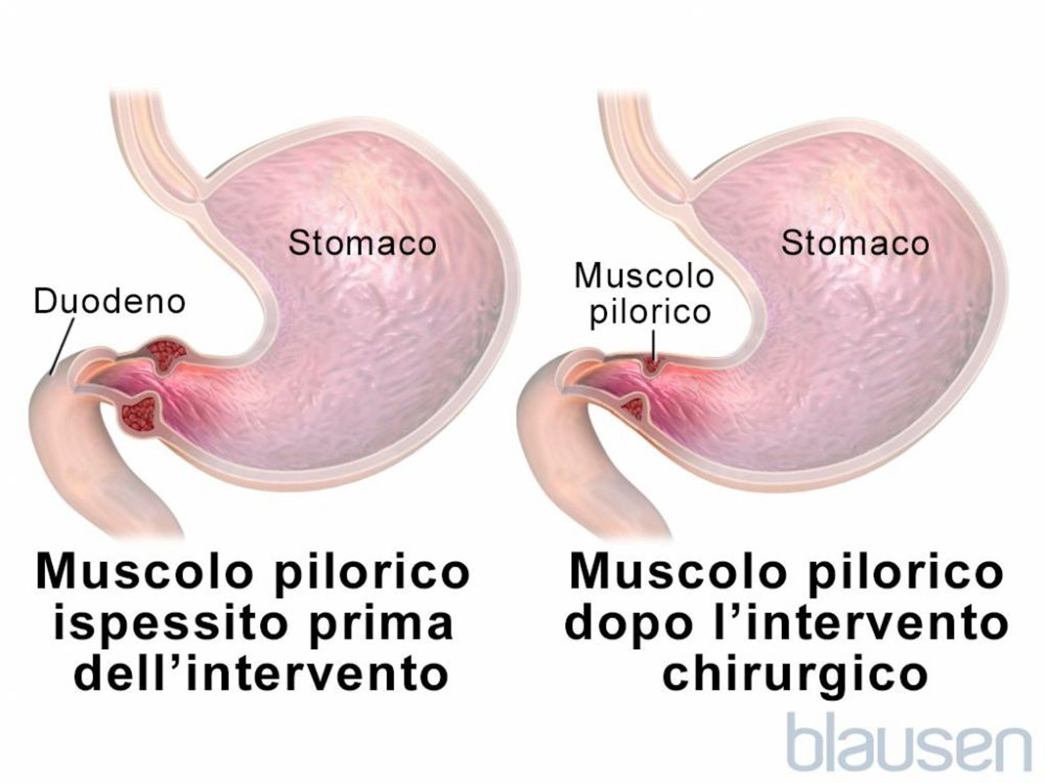 Stenosi pilorica