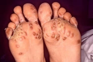 Die Füße betreffende reaktive Arthritis