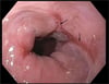 Erosive Esophagitis Caused by Gastroesophageal Reflux