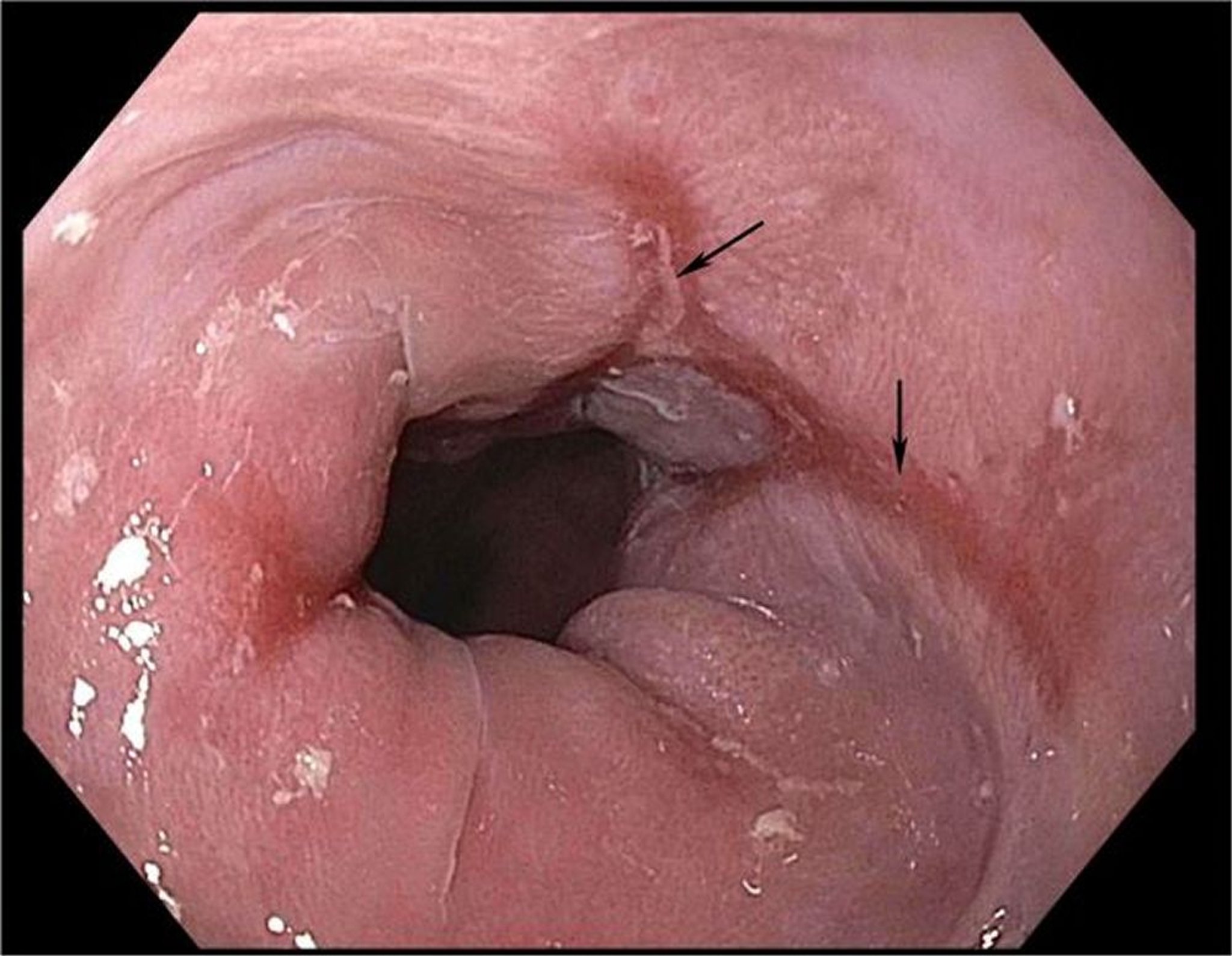Esofagite causada por refluxo gastroesofágico