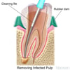 Root Canal