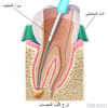 معالجة قناة الجذر