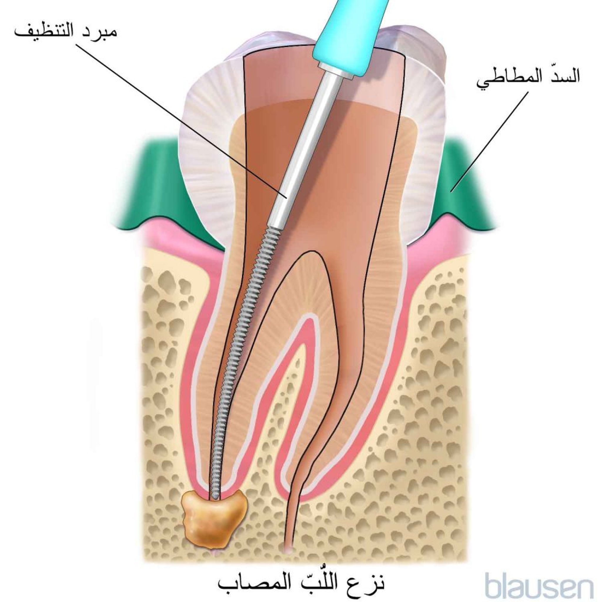 معالجة قناة الجذر