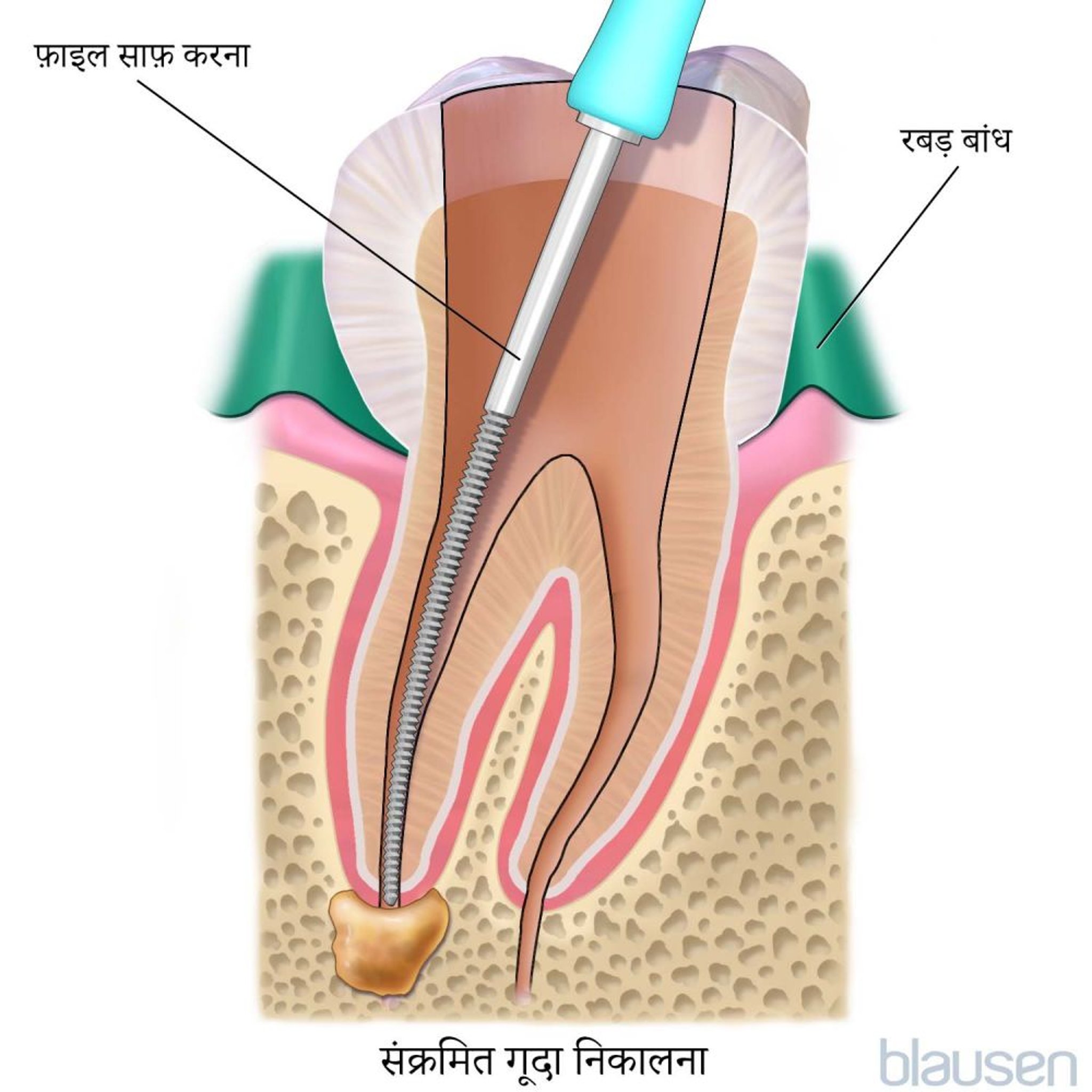 रूट कैनाल