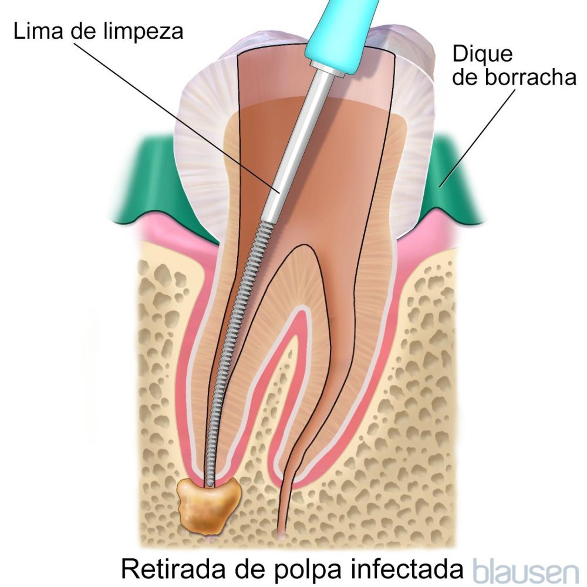 Canal radicular