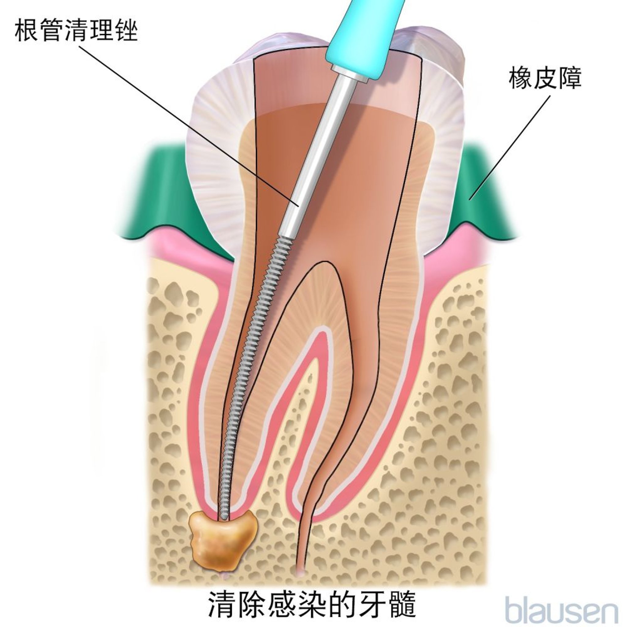 根管