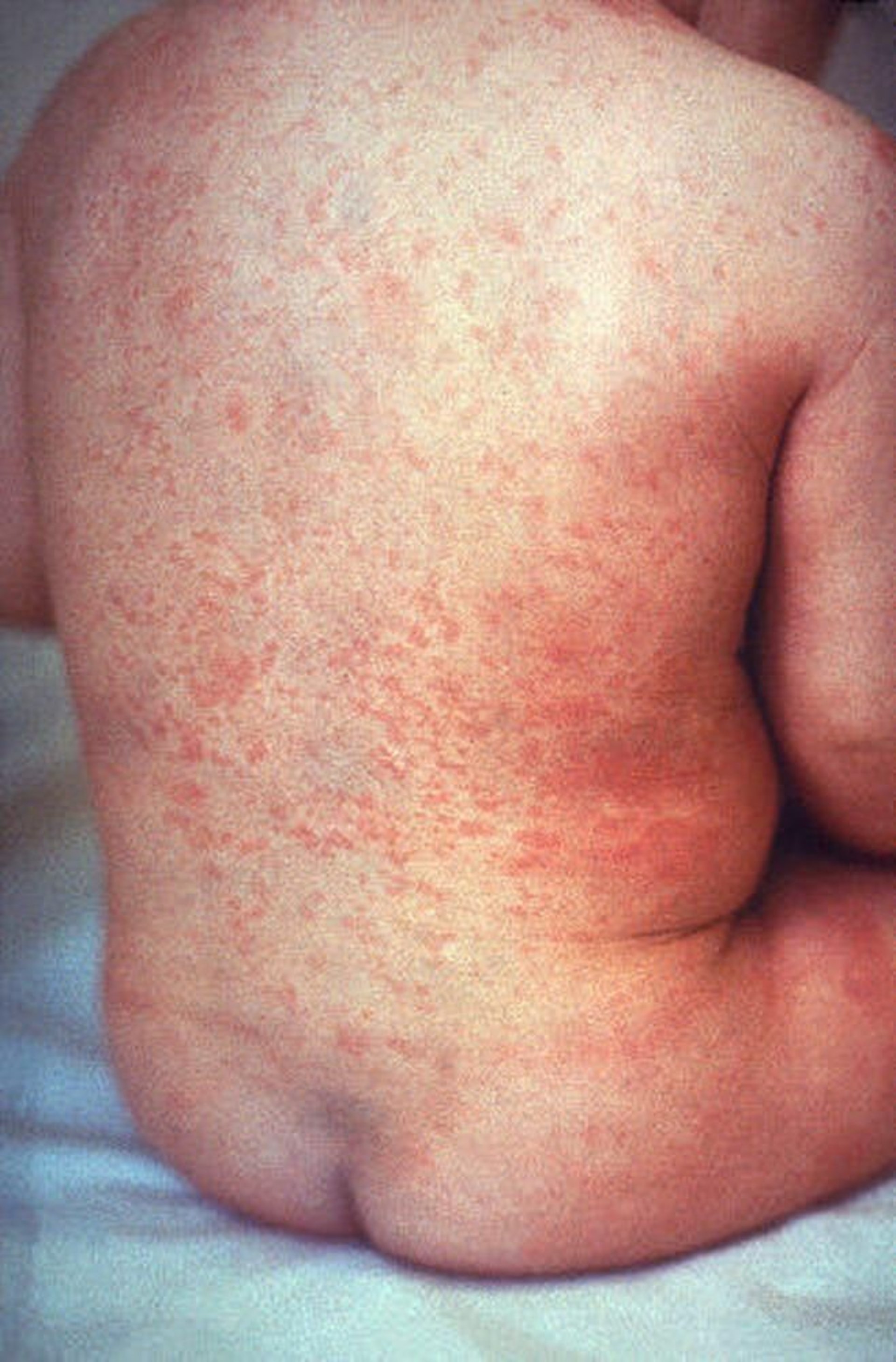風疹の発疹