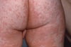 Measles Rash