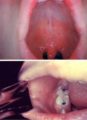 Koplik Spots in Measles (1)