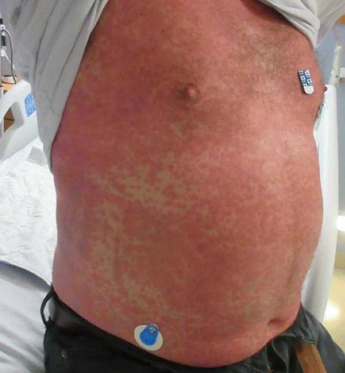 Eruzione cutanea causata da una reazione a un farmaco (torso)