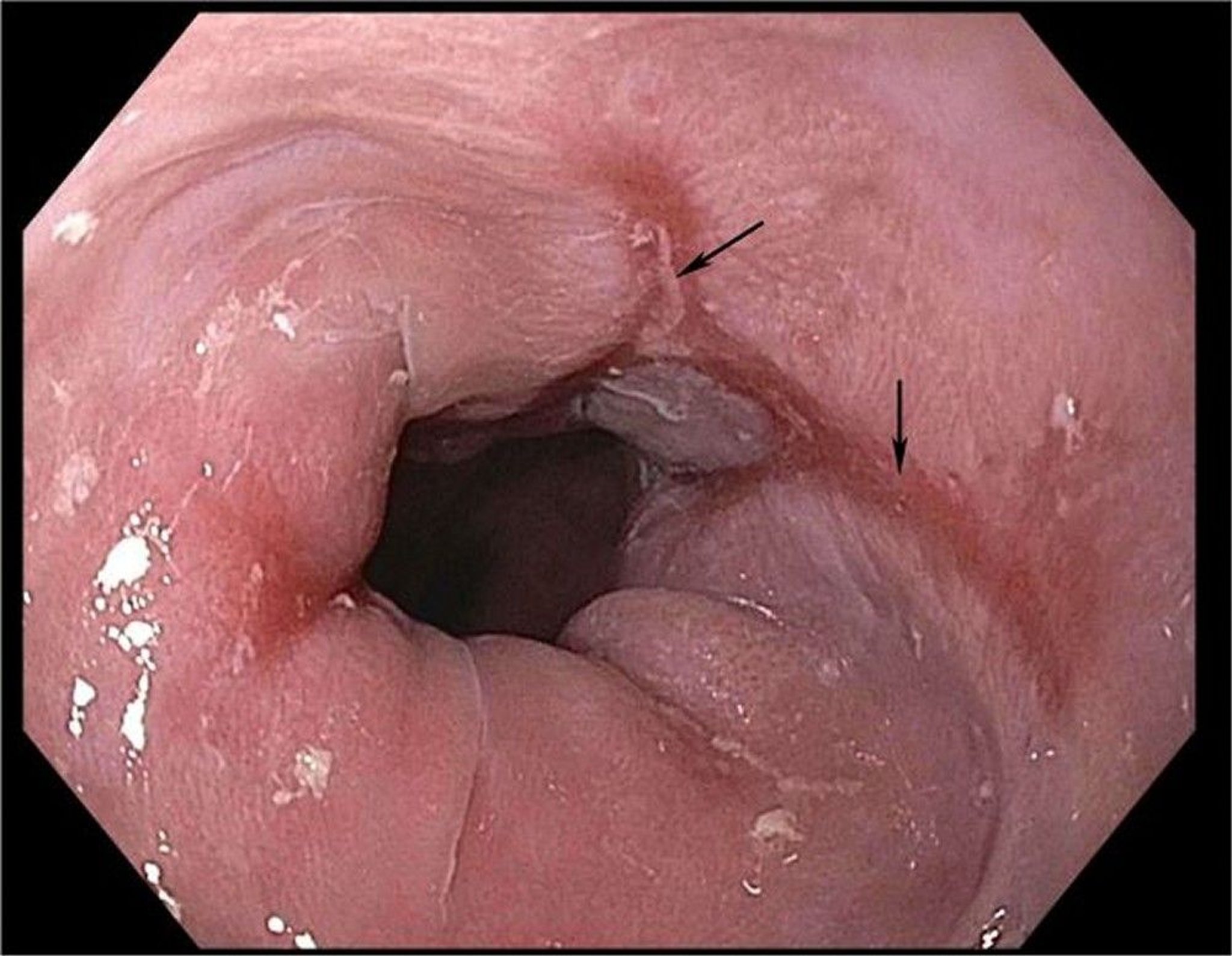 Esofagitis Erosif yang Disebabkan oleh Refluks Gastroesofagus