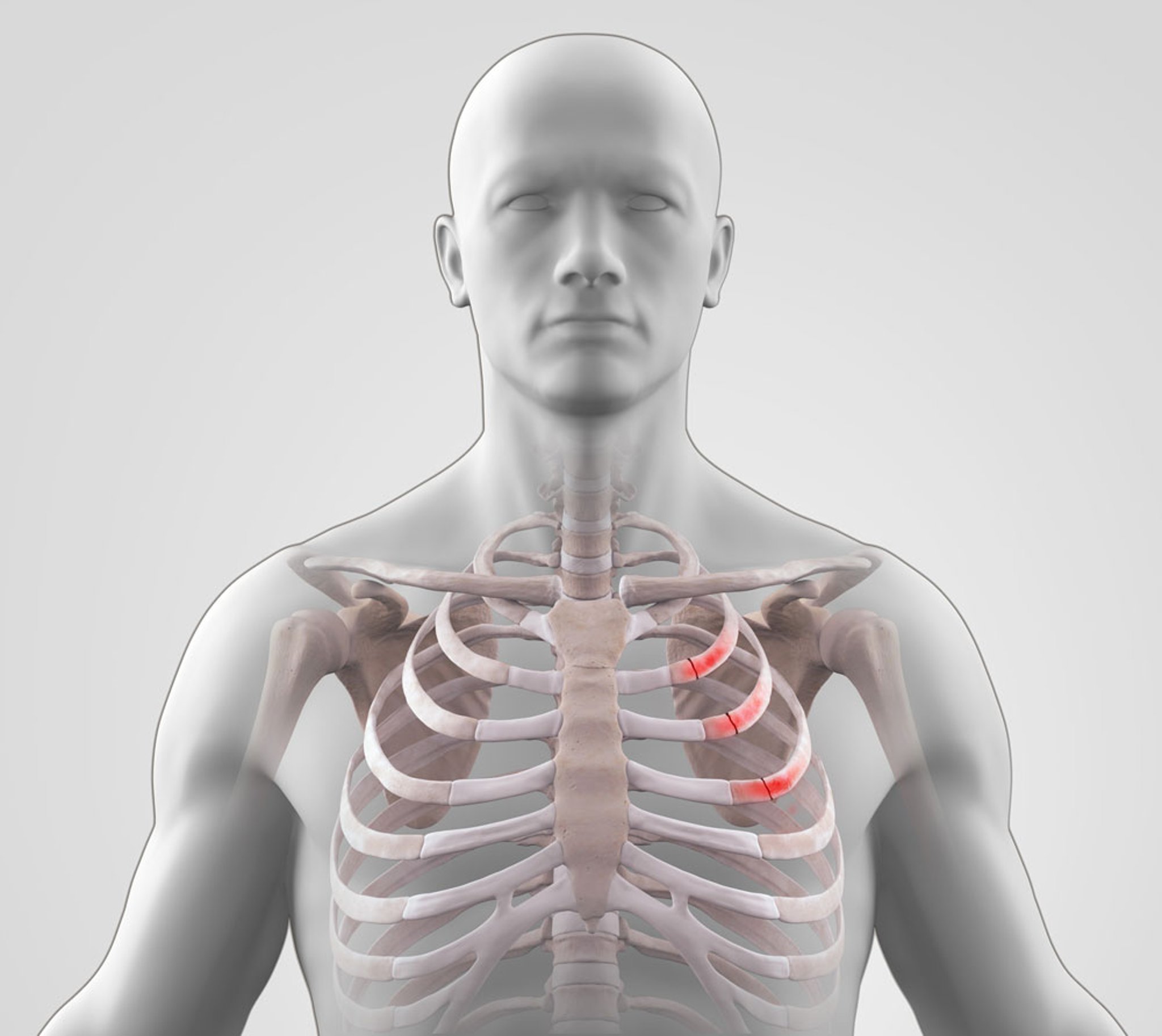 Rib Fractures - Injuries and Poisoning - Merck Manual Consumer Version