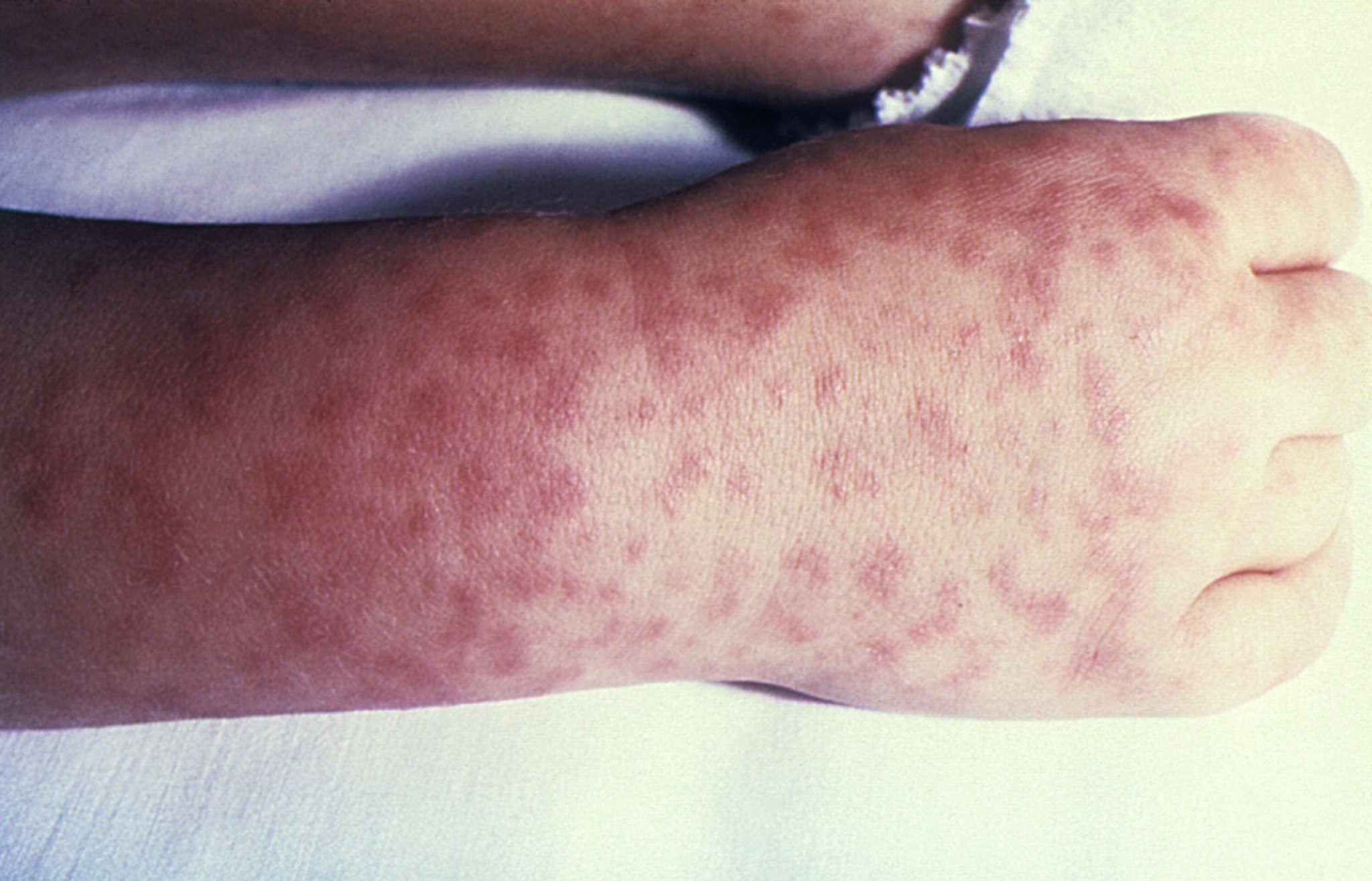 Characteristic Rash Mor Image:Rocky Mountain Spotted Fever Rash (3)-Merck Manual Consumer Version
