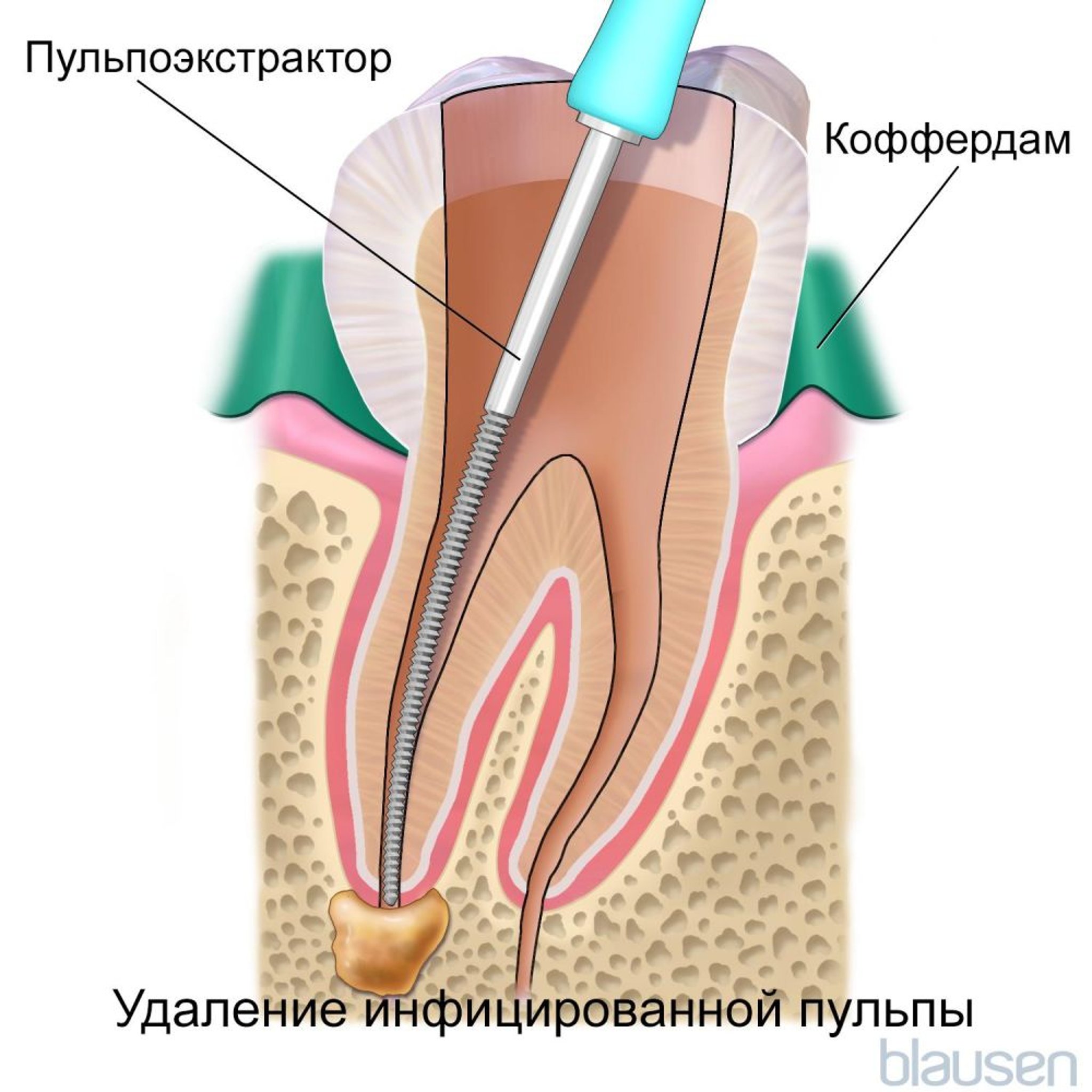 Корневой канал