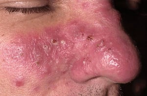 Rosacea