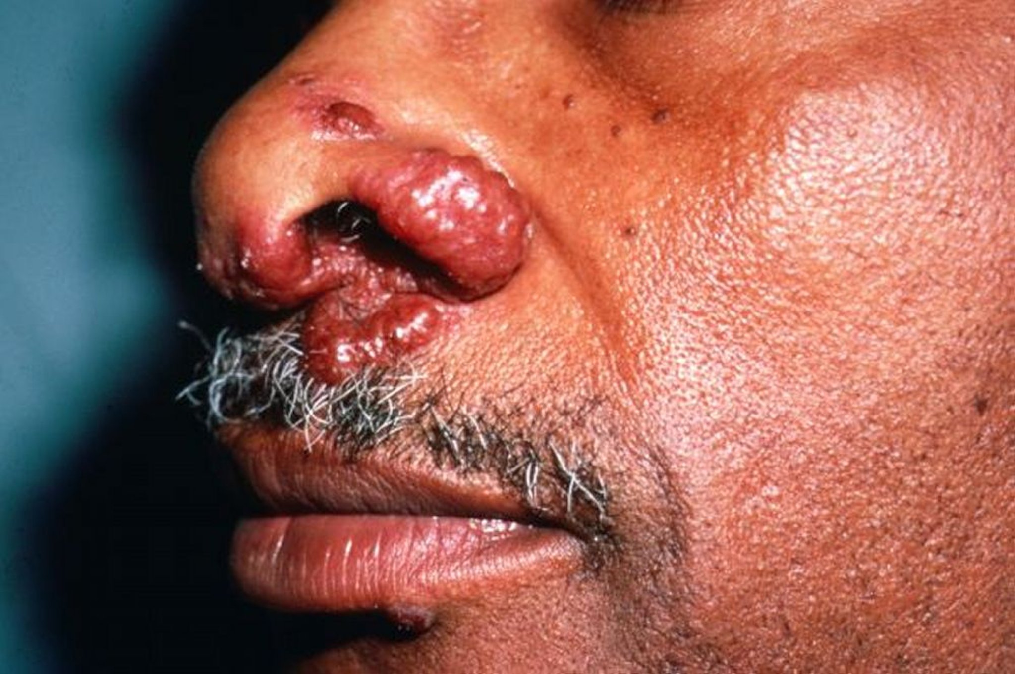 Sarcoidosis cutánea (nódulos)