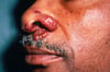 Sarcoïdose (nodules)