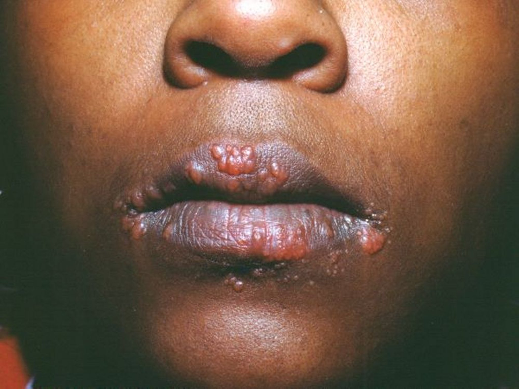 Sarcoidose (papular)