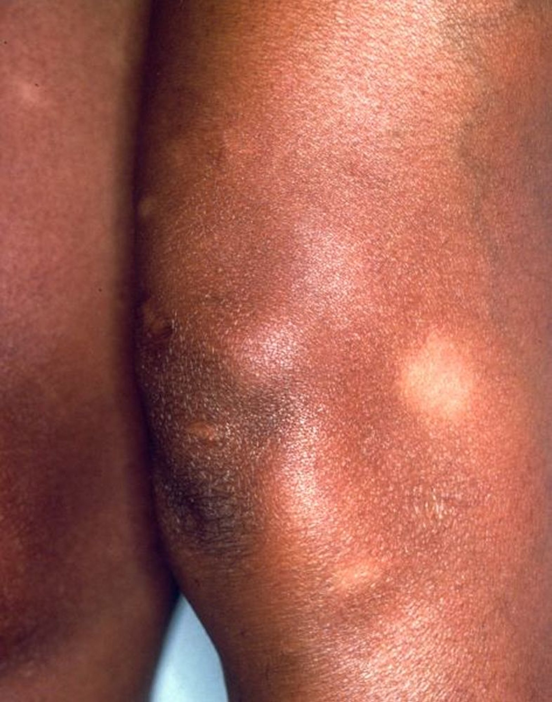 Sarcoidosis cutánea (pérdida del color de la piel)