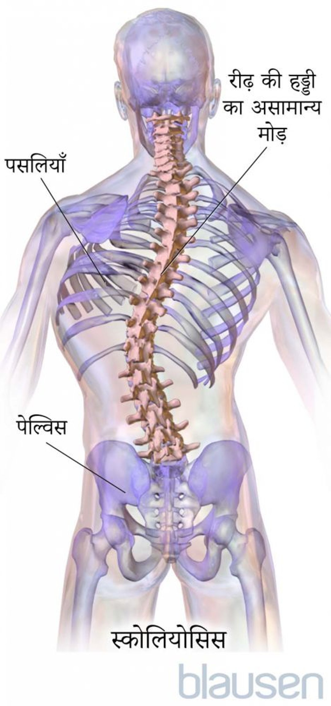 स्कोलियोसिस के लिए ब्रेसिज़
