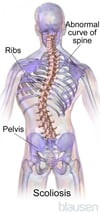 Scoliosis