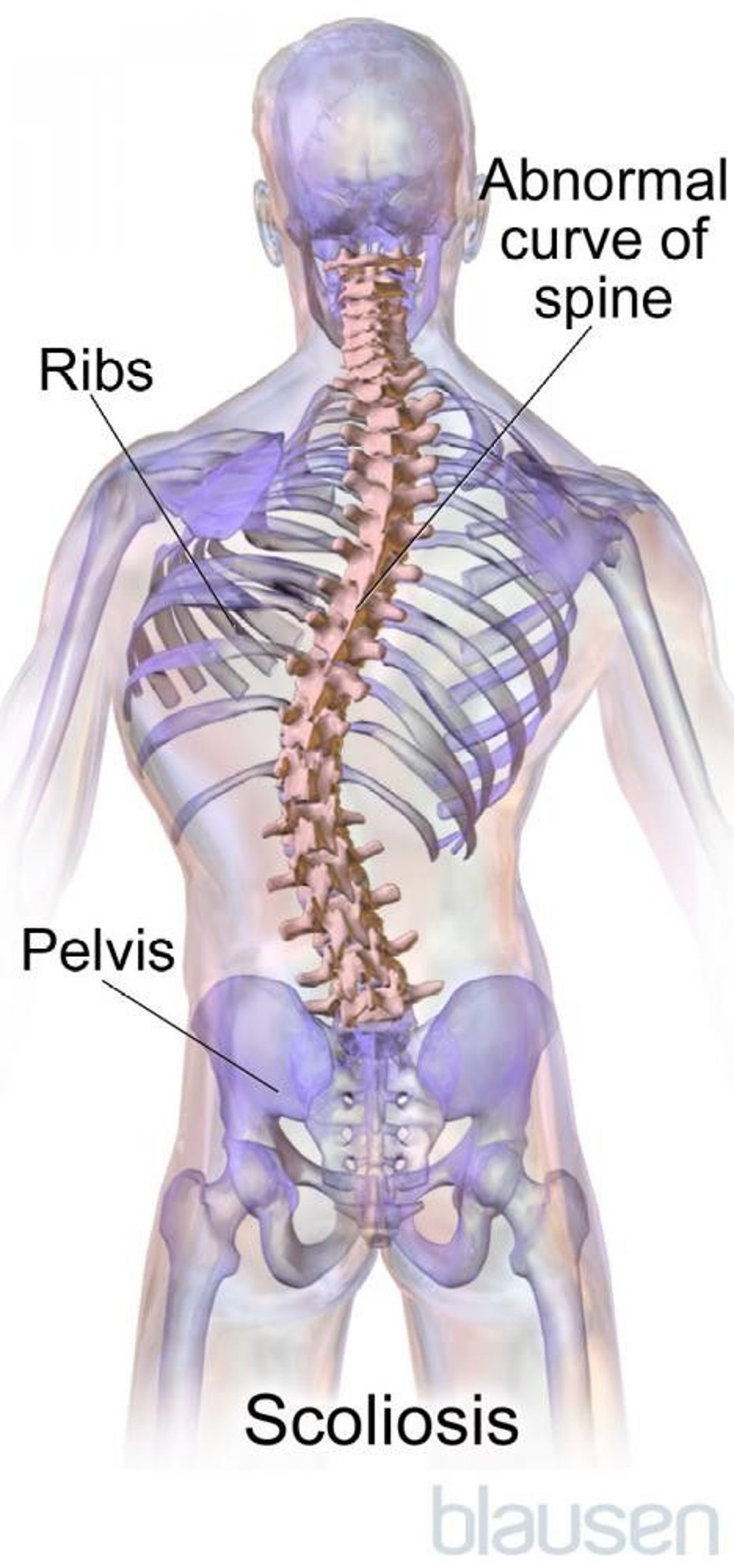 Scoliosis