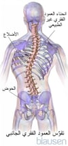 الجَنَف scoliosis