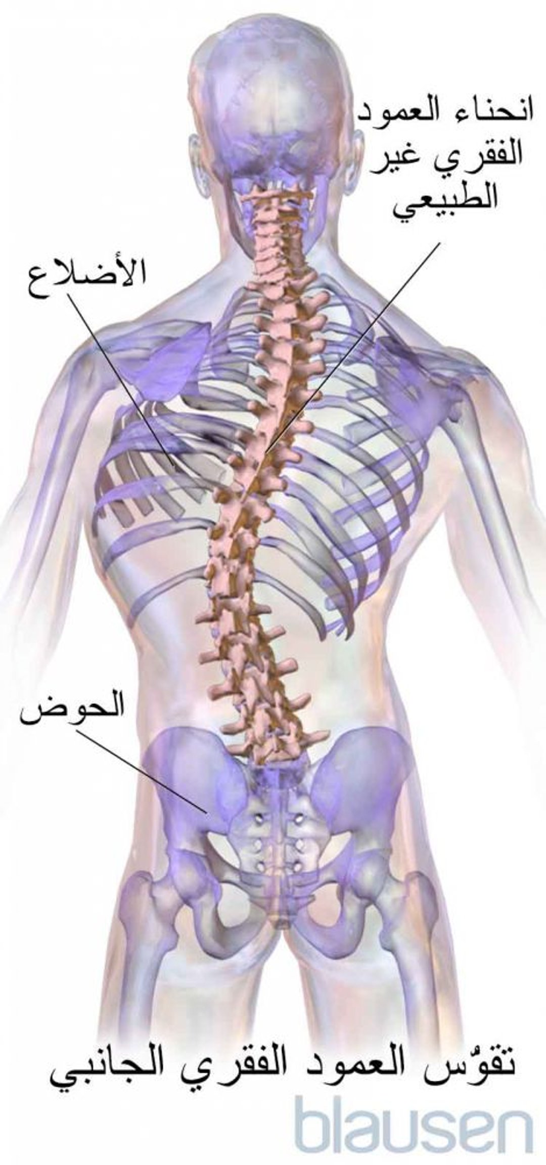 الجَنَف scoliosis