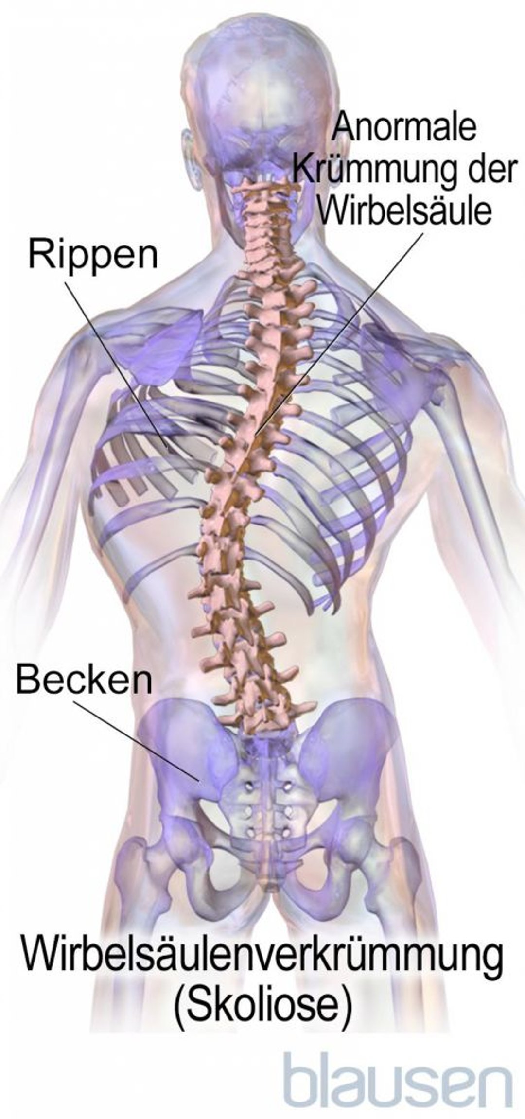 Skoliose