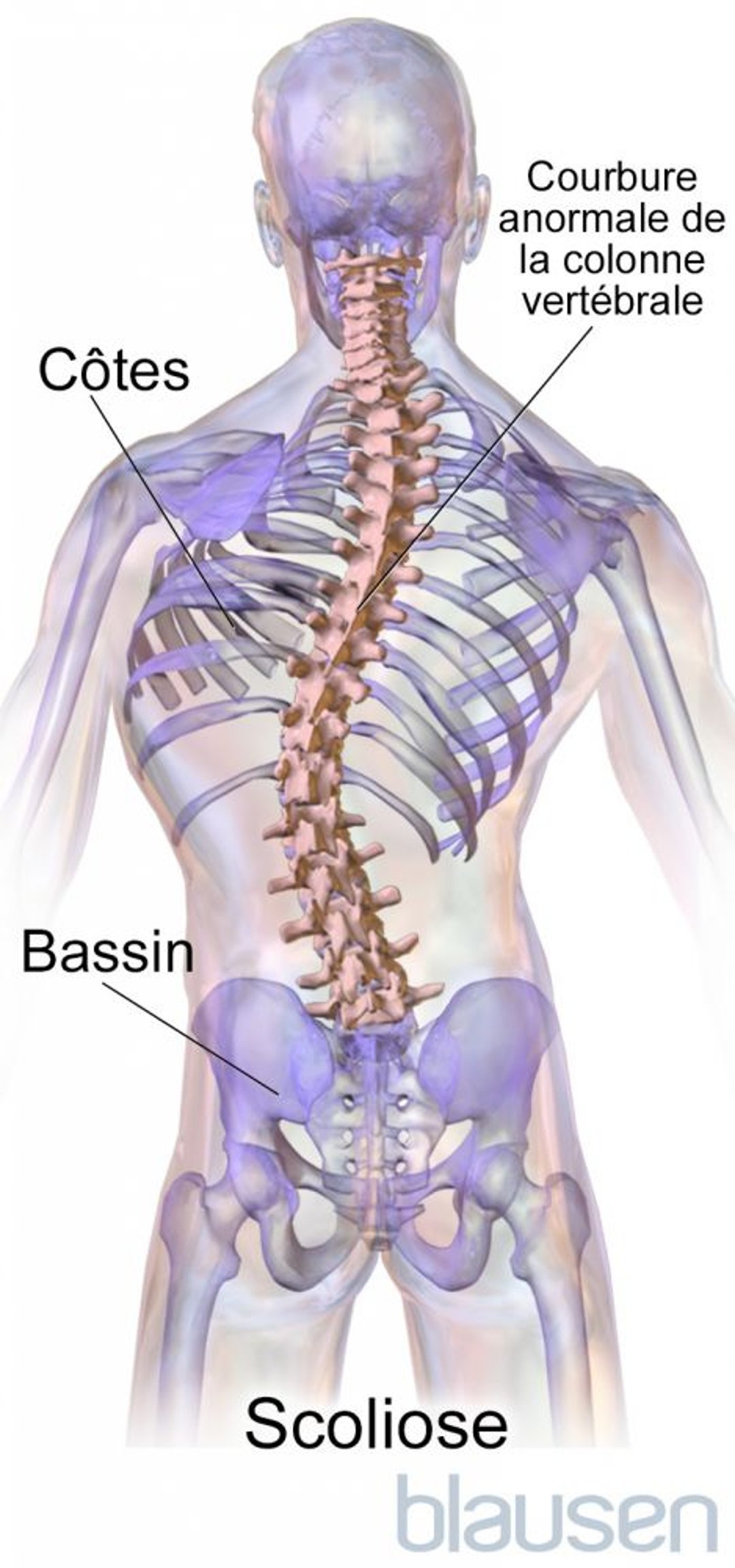 Scoliose