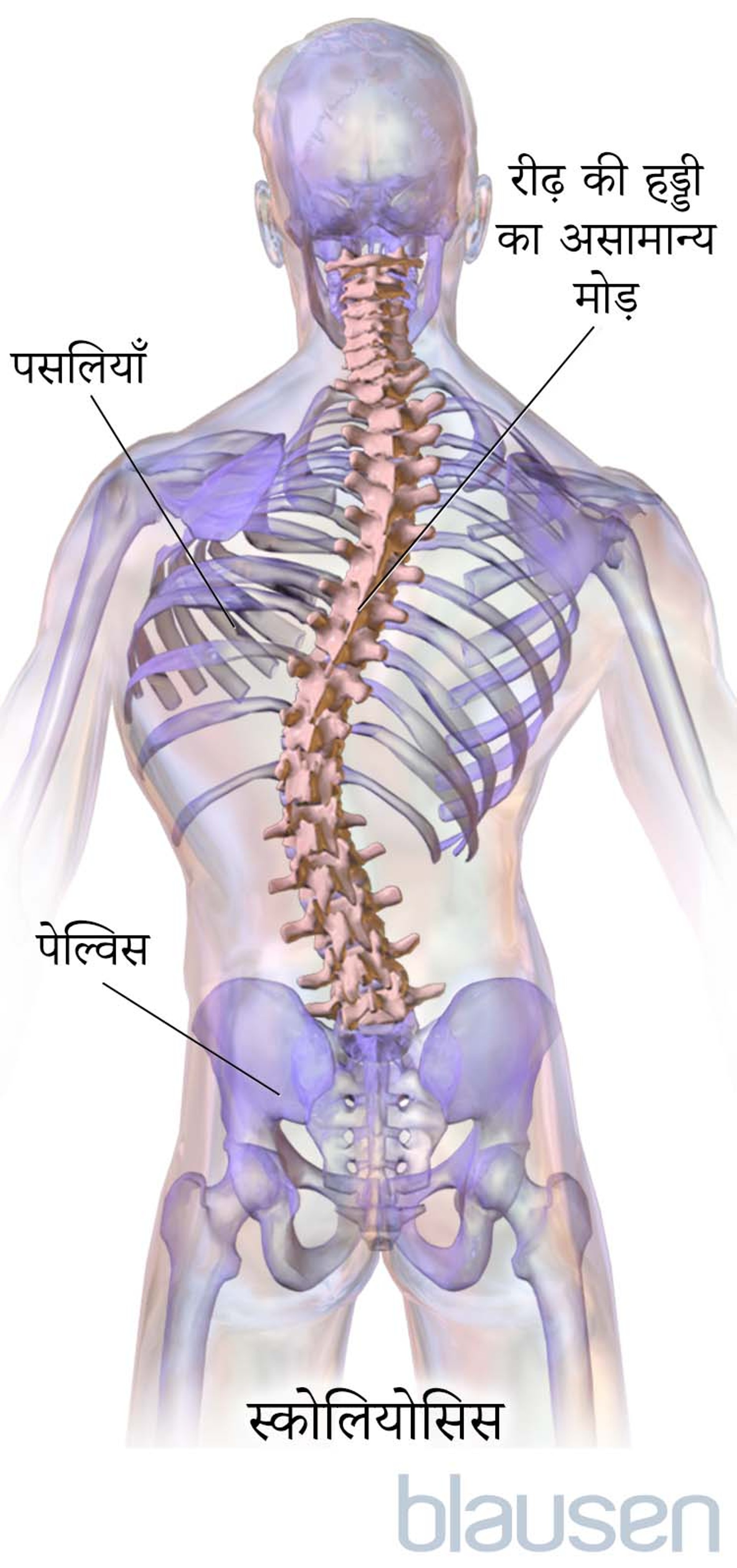 स्कोलियोसिस