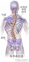 척추측만증