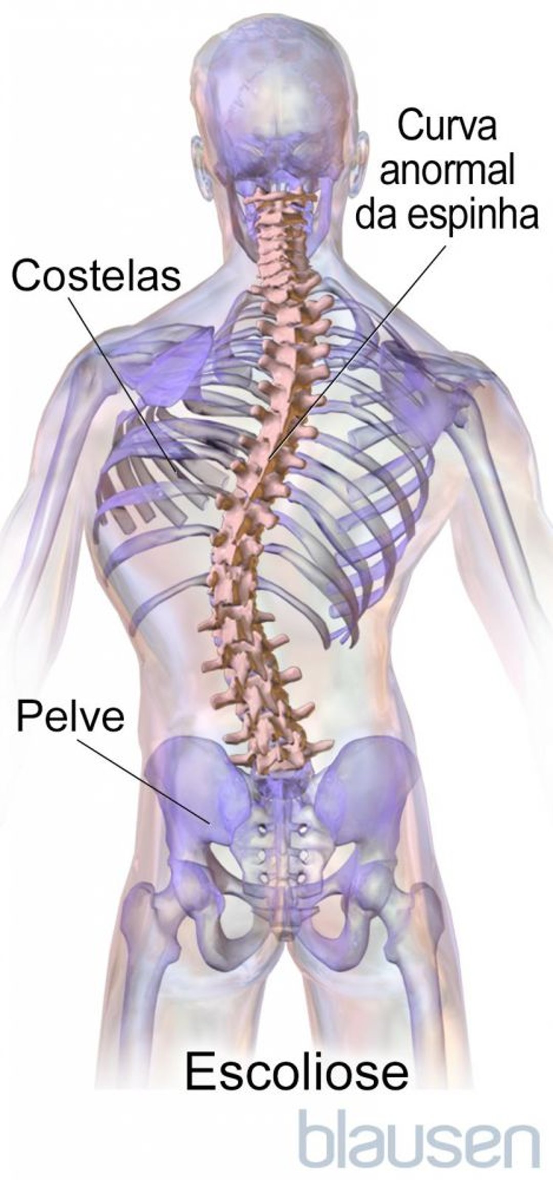 Escoliose
