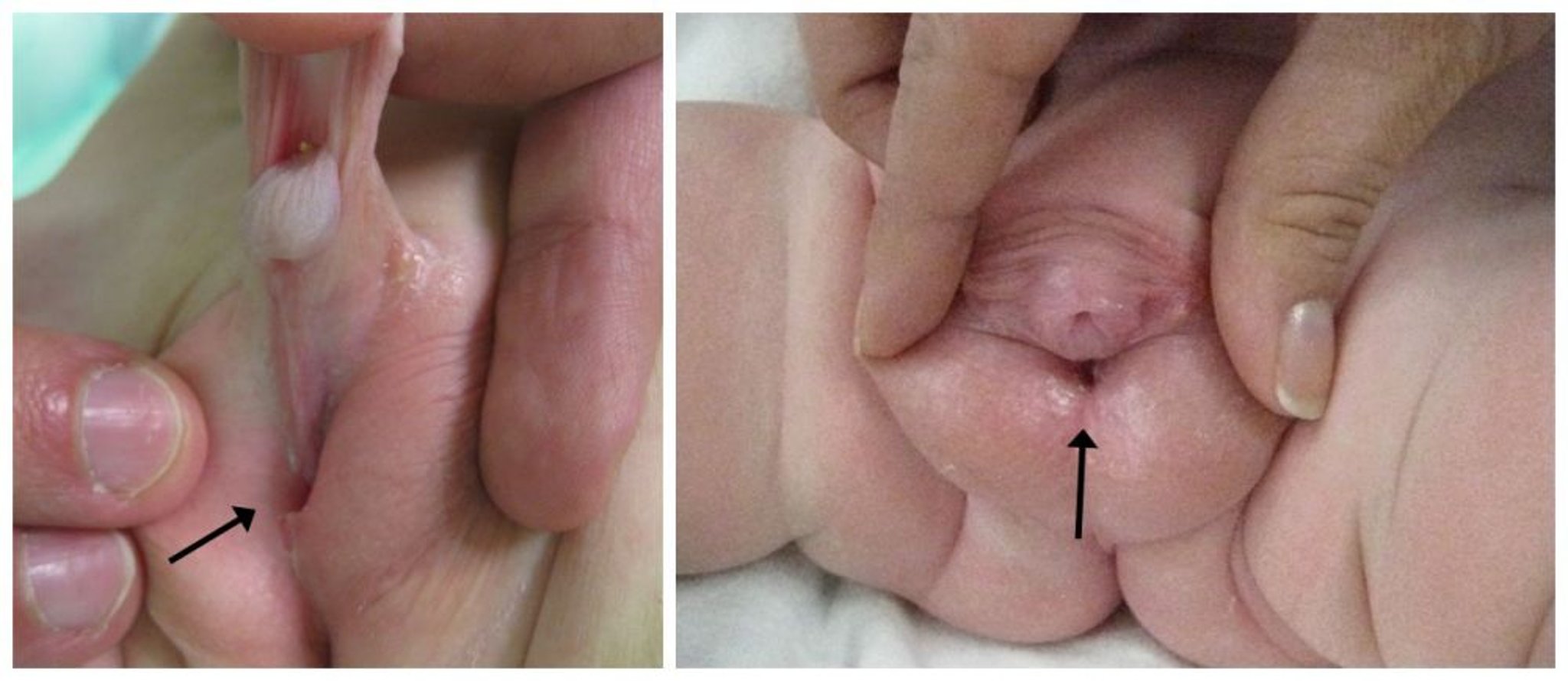 المَبال التَحتانِيّ hypospadias