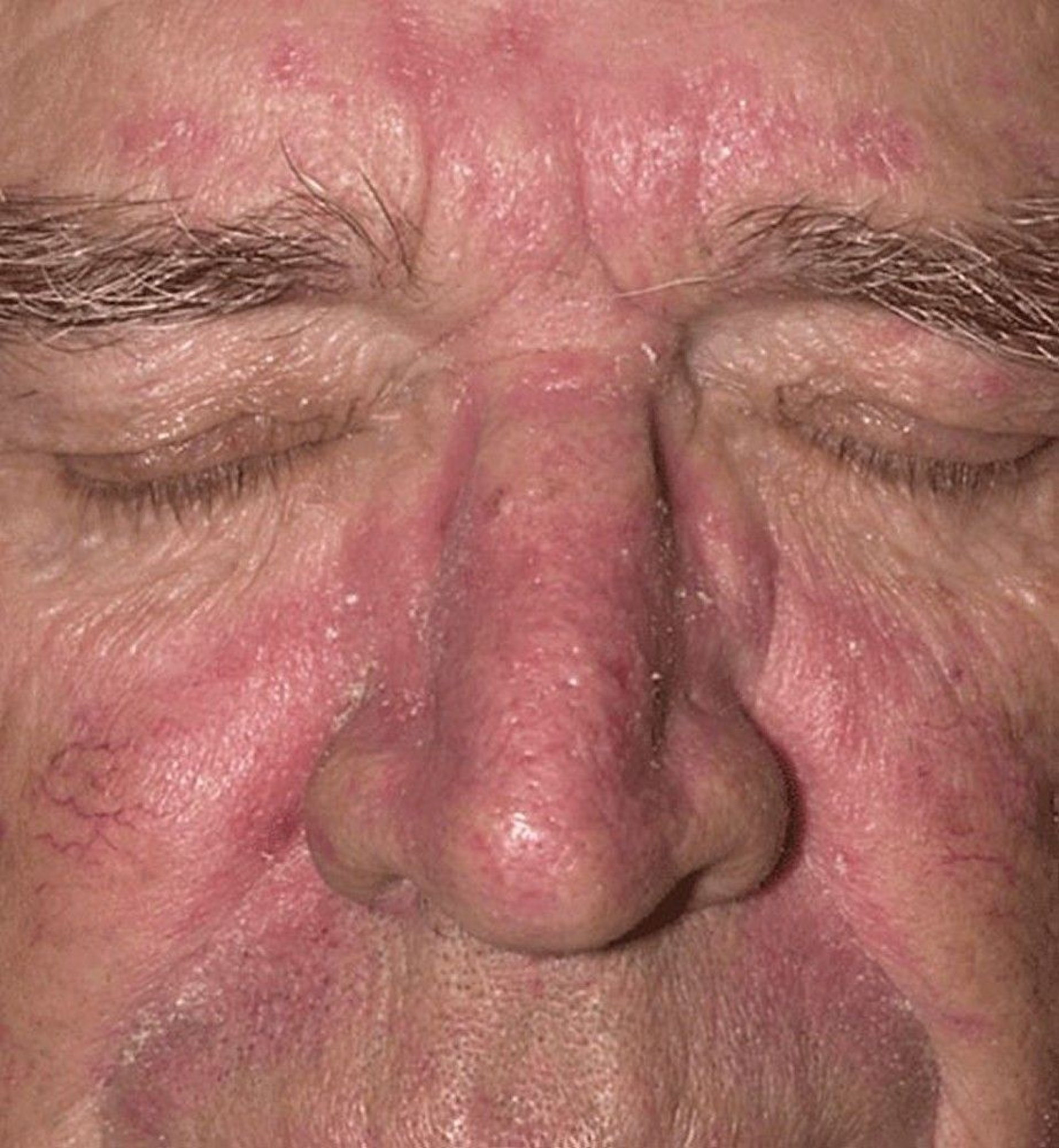 Seborrheic Dermatitis (Face)