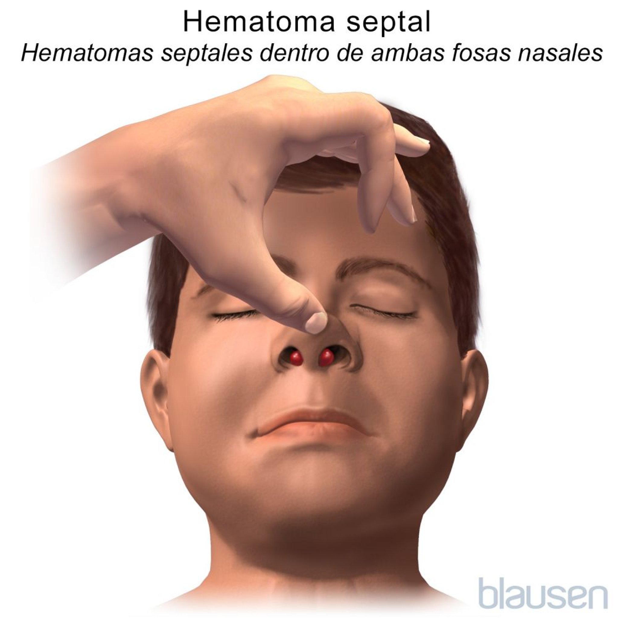 Hematoma septal