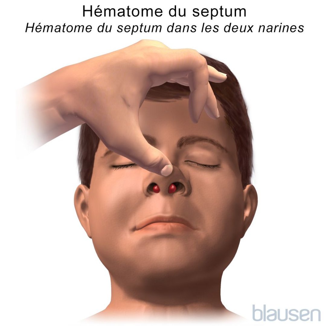 Fractures du nez Lésions et intoxications Manuels MSD pour le grand public